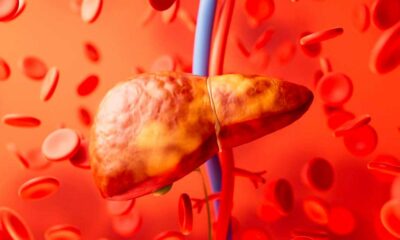 Lebersteatose und Cannabinoide